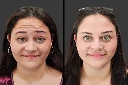 Results OF Botox for Crow’s Feet Islamabad