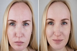 Results OF Botox for Crow’s Feet clinic Islamabad