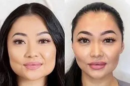 Results OF Botox for Crow’s Feet in Islamabad