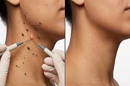 Results OF Electrocautery for Warts Removal Islamabad