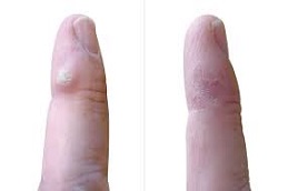 Results OF Electrocautery for Warts Removal in Islamabad