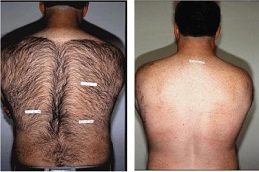 Results OF Laser Hair Removal For Back Area Clinic Islamabad