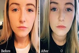 Results OF Top Lip Line Filler clinic in Islamabad