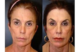 Results OF Top Lip Line Filler treatment Islamabad