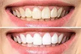 Results of Teeth Whitening Islamabad