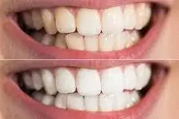 Results of Teeth Whitening clinic Islamabad