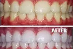 Results of Teeth Whitening clinic in Islamabad