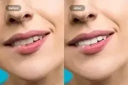 Results of Teeth Whitening in Islamabad