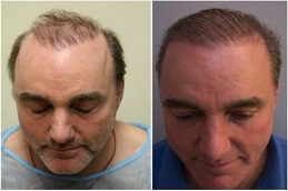 Robotic Hair Transplant Before and After clinic islamabad,
