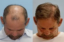Robotic Hair Transplant Before and After clinic islamabad Pakistan