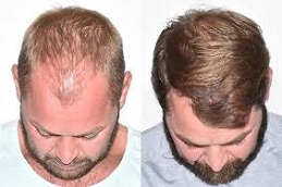 Robotic Hair Transplant Before and After clinic islamabad
