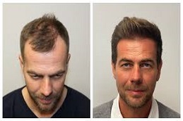 Robotic Hair Transplant Before and After in Islamabad
