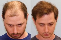 Robotic Hair Transplant Before and After in clinic islamabad