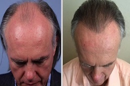 Robotic Hair Transplant Before and After,