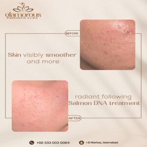 Salmon DNA Treatment lBefore & After Islamabad At Glamorous Clinic