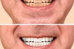 Teeth Whitening Before & After Islamabad