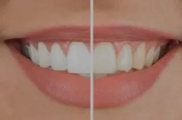 Teeth Whitening Before & After in Islamabad