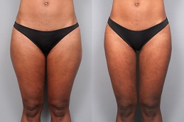 Thigh Liposuction Before and After Islamabad,