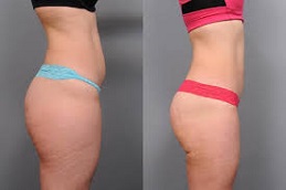 Thigh Liposuction Before and After clinic islamabad
