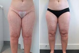 Thigh Liposuction Before and After in Islamabad