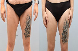 Thigh Liposuction Before and After islamabad.