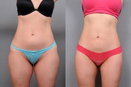 Thigh Liposuction Before and After islamabad
