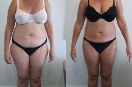 Thigh Liposuction Before and After