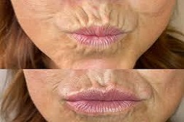 Top Lip Line Filler Before & After islamabad