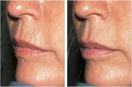 Top Lip Line Filler Before & After