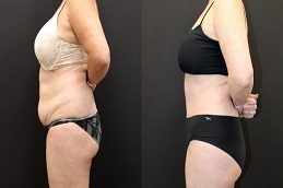 Tummy Tuck Before & After clinic Islamabad