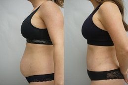 Tummy Tuck Before & After in Islamabad