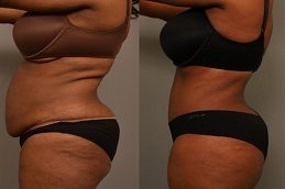 Tummy Tuck Before & After.