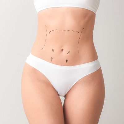Tummy Tuck in Islamabad Pakistan