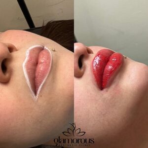 lip in islmabad At Glamrous Clinic