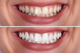 Ceramic Crown Befoe & After