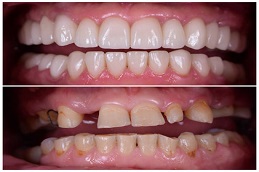 Ceramic Crown Befoe & After in islamabad,