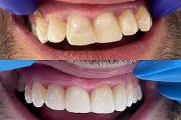 Ceramic Crown Befoe & After in islamabad