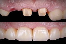 Ceramic Crown Befoe & After,