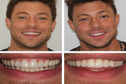 Cosmetic Dentistry Before & After clinic pakistan