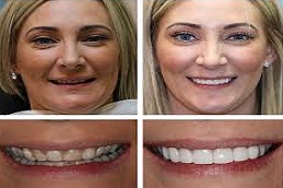 Cosmetic Dentistry Before & After in pakistan