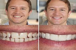 Cosmetic Dentistry Before & After islamabad