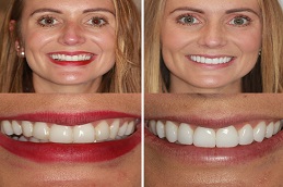 Cosmetic Dentistry Before & After pakistan