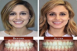 Cosmetic Dentistry Before & After