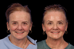 Cosmetic Injectables Before & After.