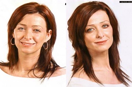 Cosmetic Injectables Before & After clinic in islamabad