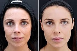 Cosmetic Injectables Before & After clinic islamabad