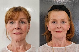 Cosmetic Injectables Before & After islamabad,