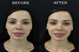 Cosmetic Injectables Before & After 