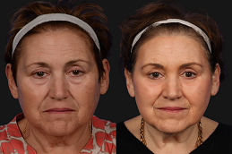 Cosmetic Injectables Before & After