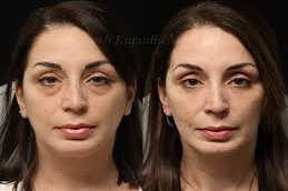 Eyelid Surgery Before & After Islamabad